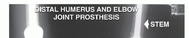 صورة توضيحية لـ استئصال الجزء البعيد من عظم العضد: تقنيات آمنة للحفاظ على الطرف في صنعاء مع الأستاذ الدكتور محمد هطيف