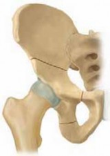Triple Innominate Osteotomy: Restoring Hip Stability Around the Femoral Head