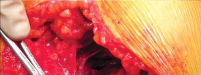 صورة توضيحية لـ تقنية الجذع القصير لاستبدال مفصل الورك الكلي: نهج الأستاذ الدكتور محمد هطيف لتدخل جراحي أقل ونتائج أفضل