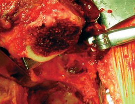 صورة طبية: طول عمر مكون الحُق الأسمنتي في مفصل الورك: مفتاح الاستقرار والديمومة مع الأستاذ الدكتور محمد هطيف في صنعاء