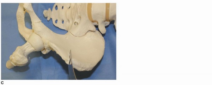 Illustration 18 for Periacetabular Osteotomy: Realigning your hip via the superior pubic ramus