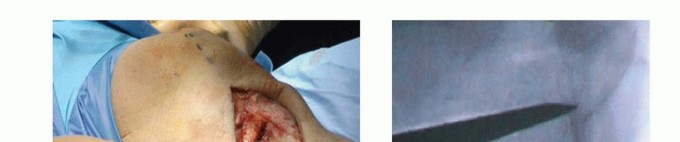 Illustration 15 for High Tibial Osteotomy: Realignment for Lasting Knee Pain Relief