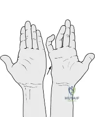 Dupuytren's: Preventing Damage to Your Distal Interphalangeal Joint