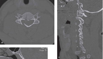 Illustration 31 for Adjacent Segment Degeneration: Your Next Spine Case Solved