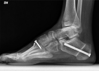 Illustration 5 for Pes Cavus & Ankle Pain: When to Use Coleman Block Testing