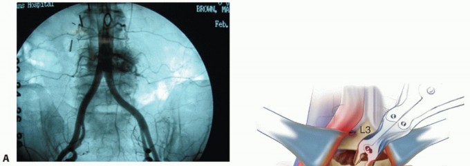 Illustration 18 for Anterior Lumbar Interbody: Fusion, Disc Replacement & Pain Relief