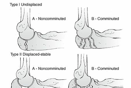 Olecranon Fractures: What to Know About Your Olecranon Injury