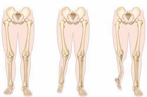Optimize Outcomes: Syme and Boyd Amputations for Fibular Deficiency