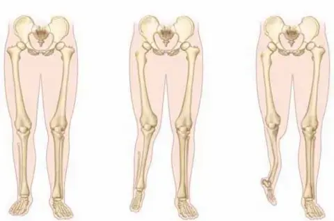 قصور الشظية: دليل شامل للمرضى حول الأسباب، الأعراض، طرق العلاج، والتعافي مع الأستاذ الدكتور محمد هطيف