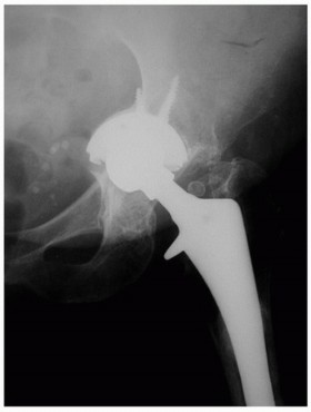 Uncemented Acetabular Revision: Optimizing Hemispherical Cup Use