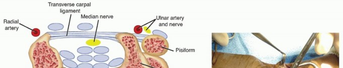 Carpal Tunnel Release: Endoscopic, Open, and Revision