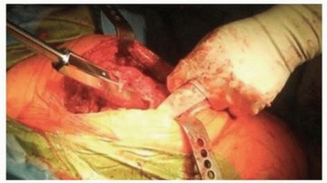 Illustration 6 for Optimizing Revision THA with Tapered Fluted Titanium Stems