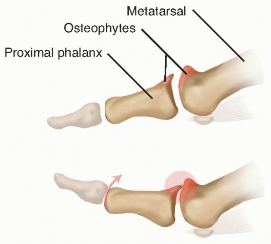 Moberg Osteotomy: The Moberg Method for Hallux Rigidus