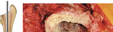 توضيح طبي: استبدال مفصل الورك الكلي بتقنية الإسمنت للفخذ: دليلك الشامل لنتائج تدوم طويلاً مع الأستاذ الدكتور محمد هطيف في صنعاء