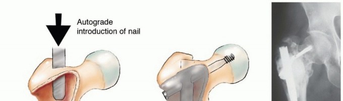 Illustration 28 for Plain Radiograph Showing MBD: Surgical Planning to Prevent Failures