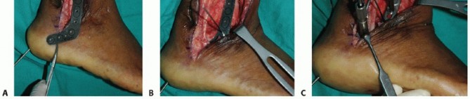 Illustration of blade plate fixation - Dr. Mohammed Hutaif