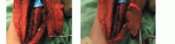 صورة طبية: ترقيع الشظية الوعائي الحر: حلول متقدمة لعيوب العظام المعقدة