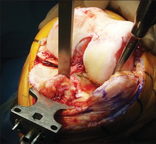 Posterior Cruciate Ligament-Retaining TKA: Navigating Pitfalls