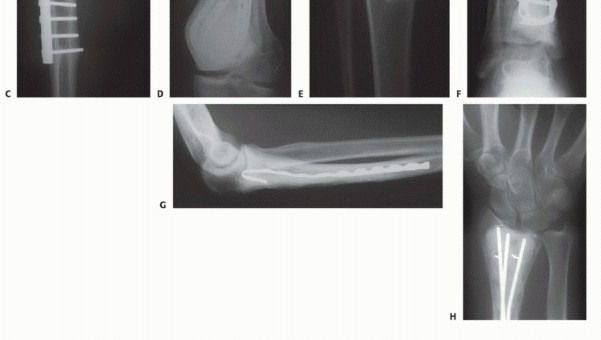 صورة طبية: تجنب الجراحة الكبرى: علاج أورام العظام بالنيتروجين السائل بتقنية الصب المباشر