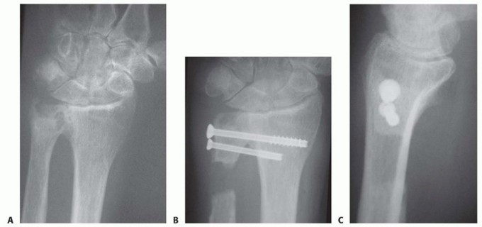 Sauvé-Kapandji Procedure for Distal Radioulnar Joint Arthritis