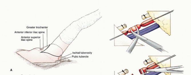 صورة توضيحية لـ استئصال مفصل الورك: دليل شامل للمرضى مع الأستاذ الدكتور محمد هطيف