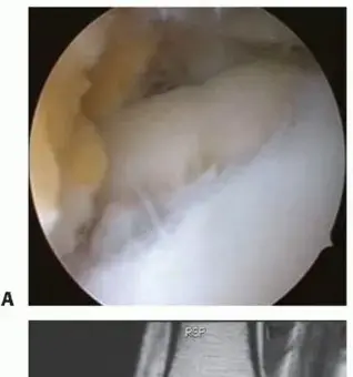 صورة توضيحية لـ زراعة الخلايا الغضروفية الذاتية للكاحل: أمل جديد لمرضى آلام المفاصل وتلف الغضروف