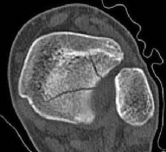 Illustration 16 for Tibial Fracture Extending into the Plafond: Intramedullary Secrets