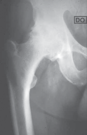 Mastering Uncemented Total Hip Arthroplasty: A Complete Guide
