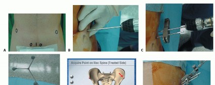 صورة طبية: ترميم مفصل الورك: الحل الأمثل للحفاظ على عظم رأس الفخذ في صنعاء مع الدكتور محمد هطيف