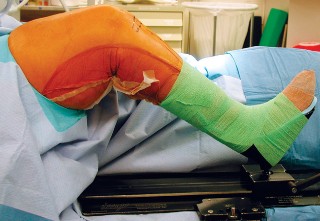 Illustration of cementless fixation cementless - Dr. Mohammed Hutaif