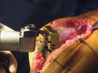 Illustration 30 for Posterior Stabilized Technique: Essential Insights for TKA Success