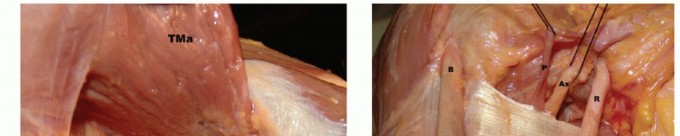 Restore Shoulder Function with Latissimus Dorsi Tendon Transfer