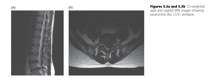 Don't Miss Cauda Equina Syndrome: Red Flags in Disc Prolapse