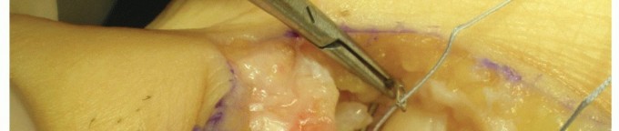 Illustration 20 for Plantar Plate Repair: End Lesser Toe Pain & Instability