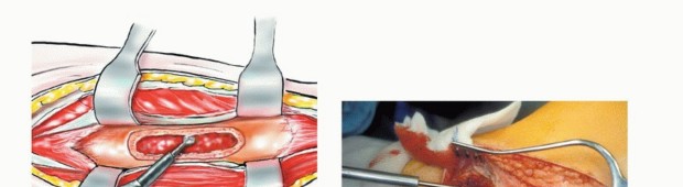 صورة طبية: استئصال أورام الشظية: دليل شامل للعلاج الحديث والحفاظ على الأطراف مع الأستاذ الدكتور محمد هطيف