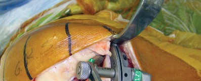 Illustration 17 for Minimize Pain, Maximize Recovery: TKA with Parapatellar