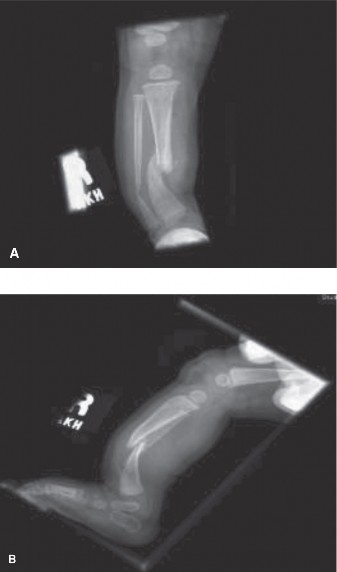 Bowed Leg & Spots: A Pediatric Orthopedic Case Challenge