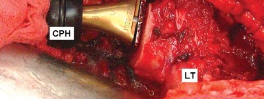 Illustration 15 for Mastering Soft Tissue Balancing for Optimal THR Outcomes