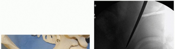 Illustration 19 for Periacetabular Osteotomy: Realigning your hip via the superior pubic ramus
