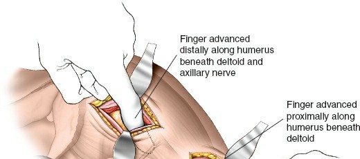 Illustration 116 for Essential Guide: Mastering Every Approach to the Shoulder