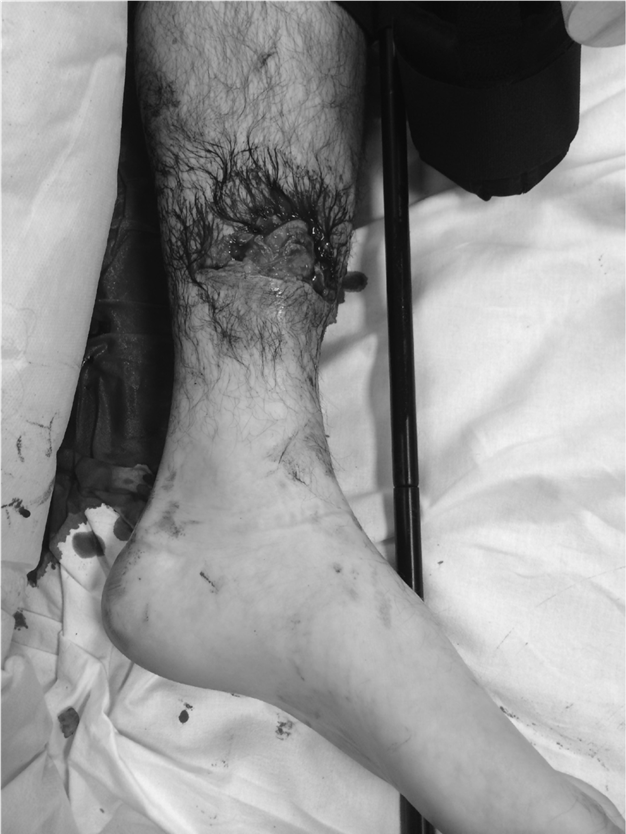 Open Fractures: Why Continuous Pressure Monitoring is Crucial