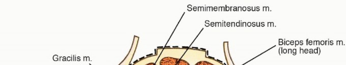 Posterior Thigh Resection: Rethinking Outcomes & Limb Sparing