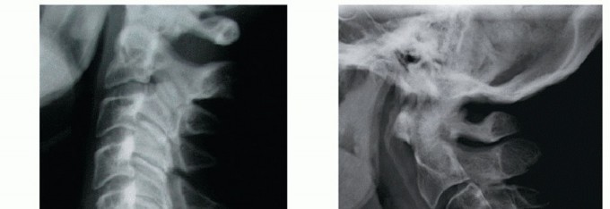 Mastering Anterior Cervical Approaches: P Tech Fig Essentials