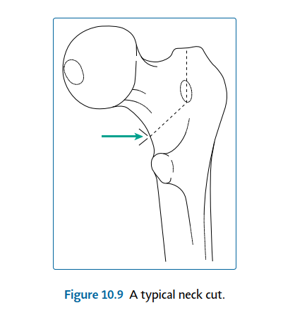 Illustration 39 for Mastering Short External Rotators for Optimal Hip Surgery Results