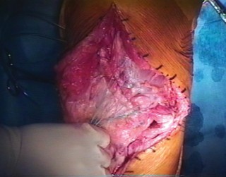 Illustration of reconstruction in total - Dr. Mohammed Hutaif