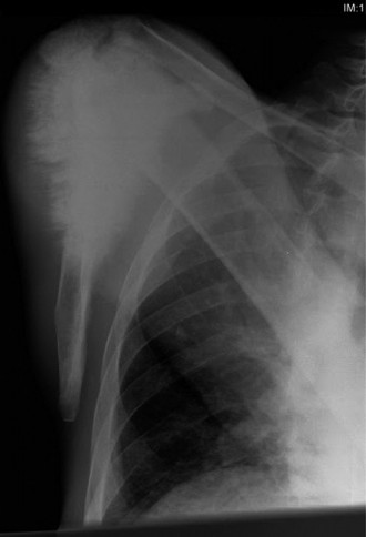 Illustration of oncology cases osteosarcoma orthopedic - Dr. Mohammed Hutaif