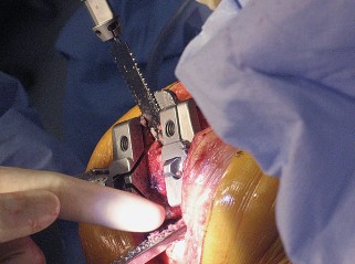 Illustration 42 for Posterior Stabilized Technique: Essential Insights for TKA Success