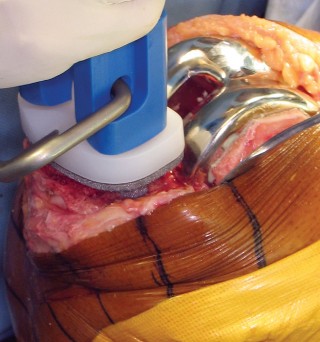 Illustration 14 for Monoblock Total Knee: When to Use & What to Avoid