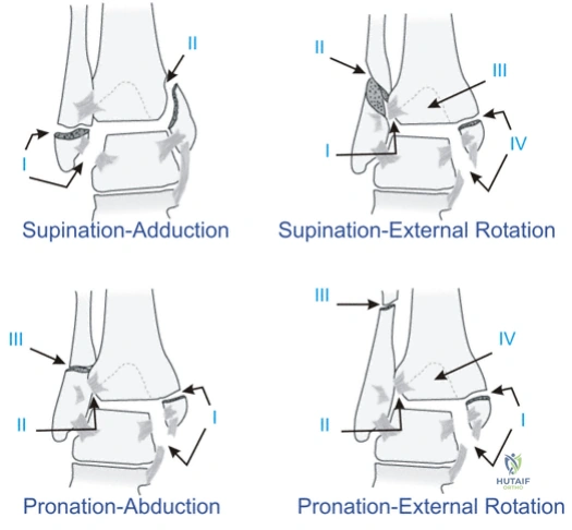 Illustration of fracture ankle fracture ankle - Dr. Mohammed Hutaif