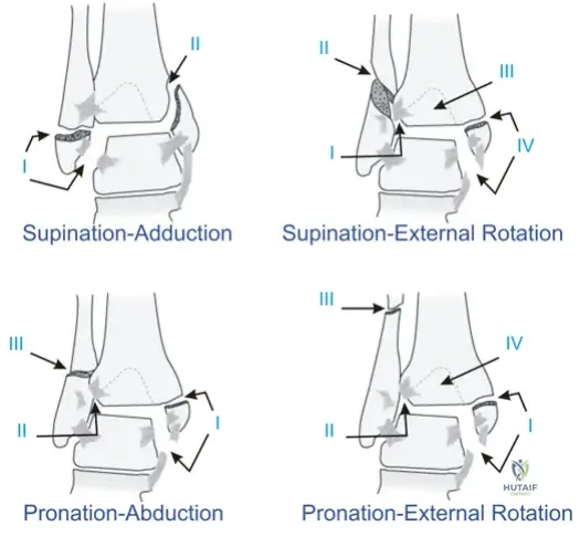 Illustration of fracture ankle fracture ankle - Dr. Mohammed Hutaif